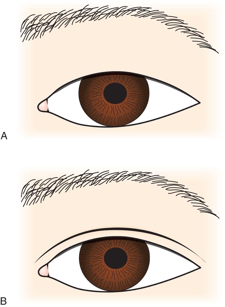 single eyelid monolid and double eyelid comparison